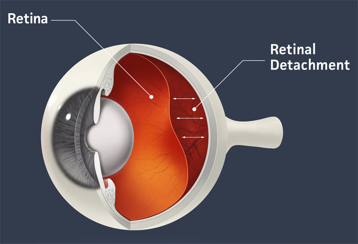 Conjunctivitis